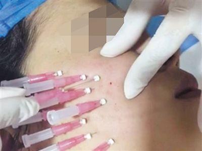 学员朋友圈发布的埋蛋白线项目注射图片.
